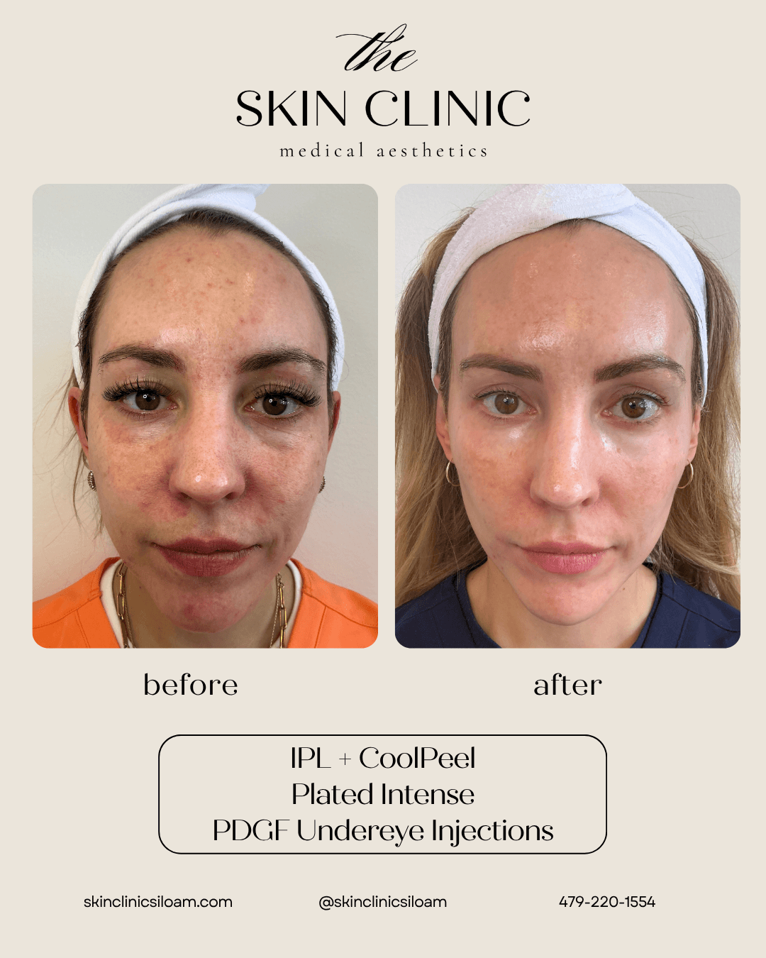 Kysse Lip Filler - Before and After