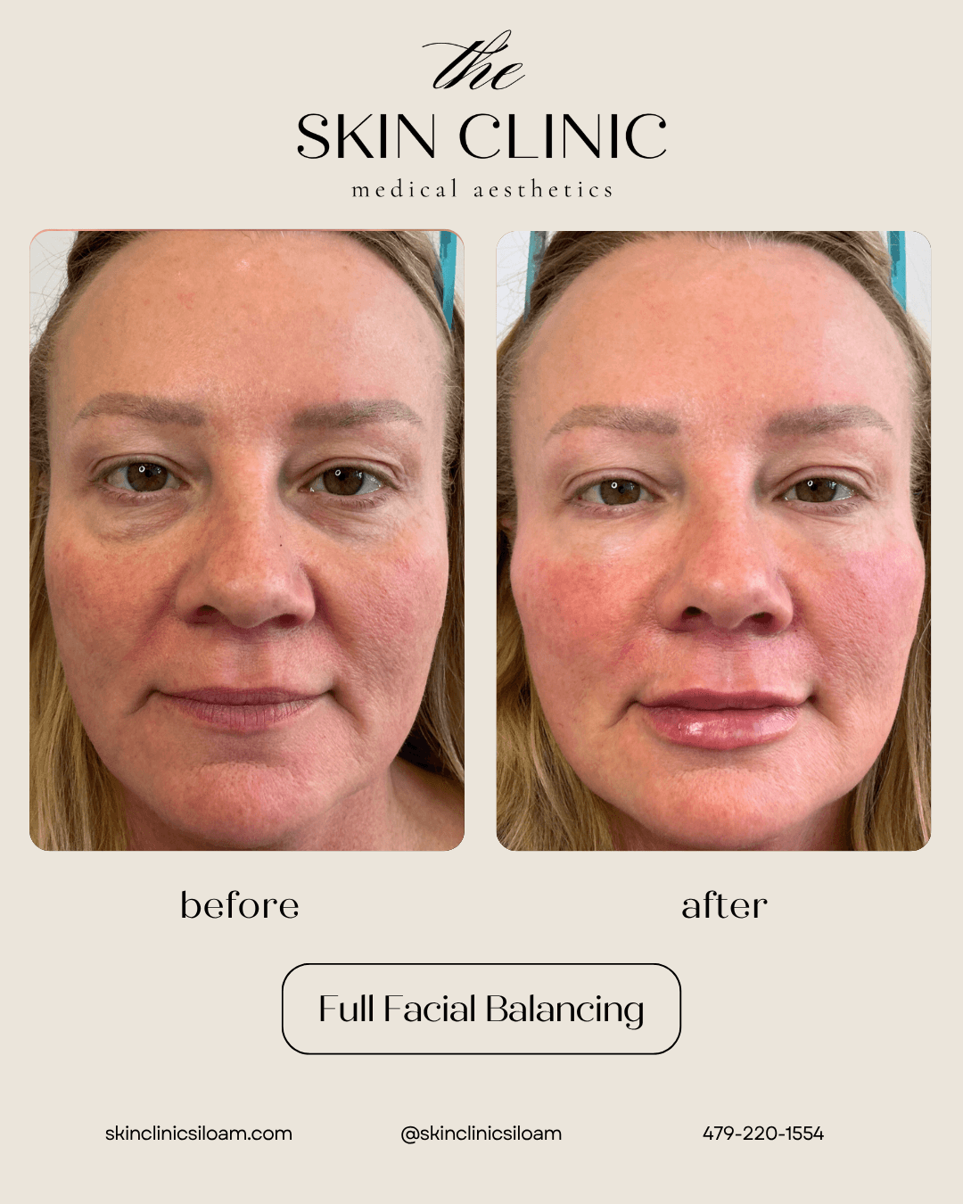 Full Facial Balancing - Before and After