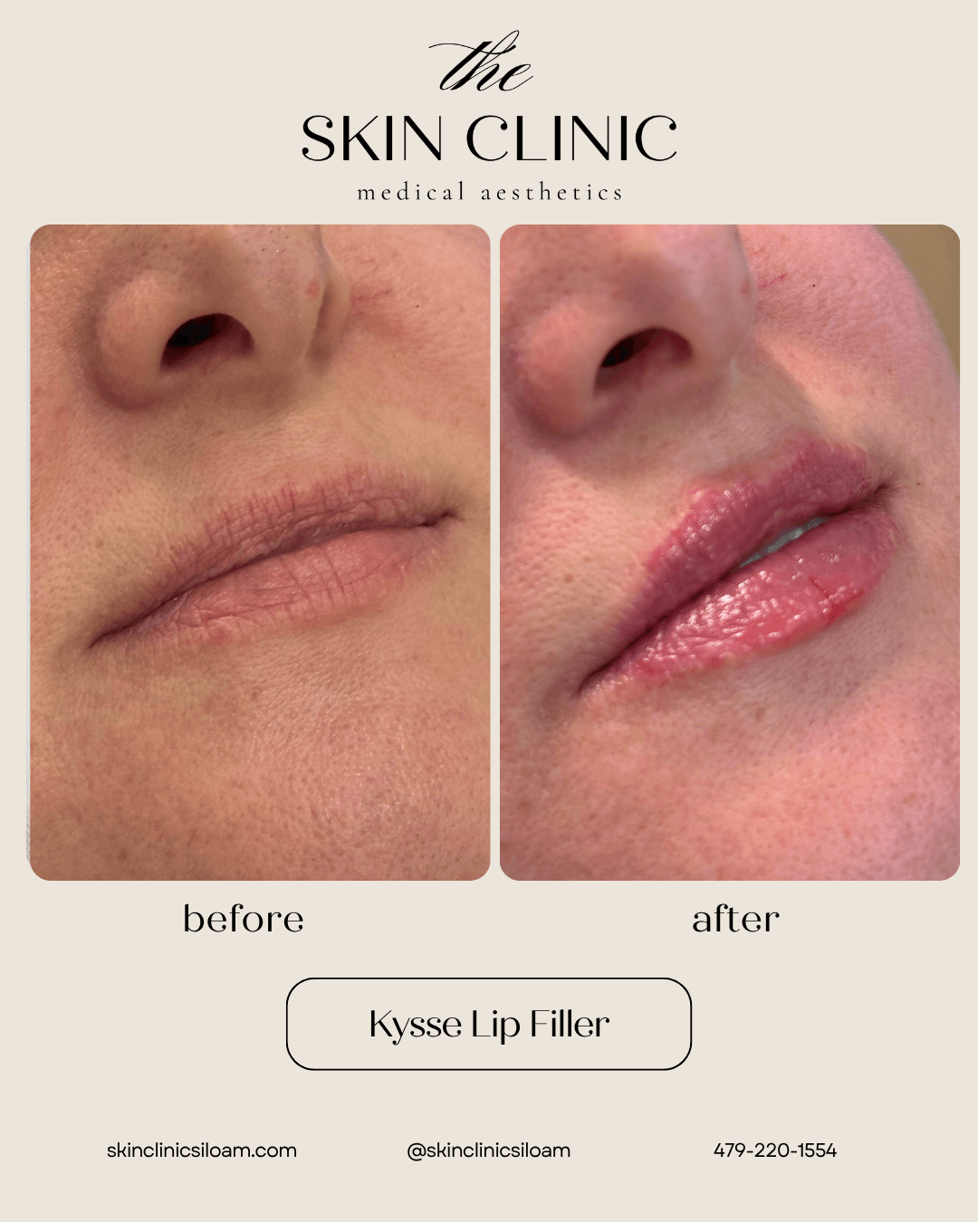 Kysse Lip Filler - Before and After