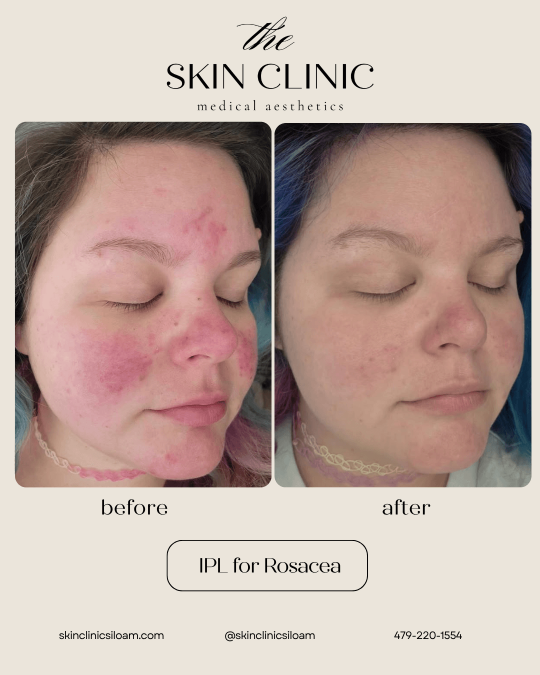 IPL for Rosacea - Before and After