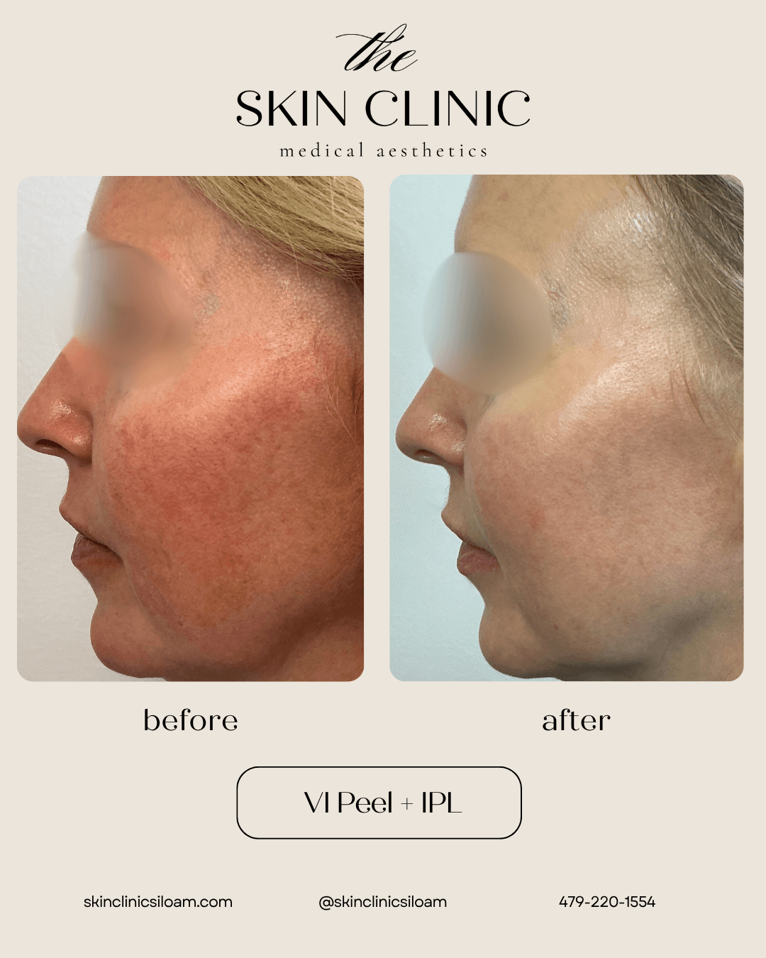 VI Peel + IPL - Before & After